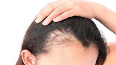 Photo of Top Natural Hair Loss Treatments for Women