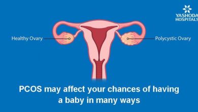 Photo of Number One Cause of Female Infertility: Polycystic Ovarian Syndrome (PCOS)
